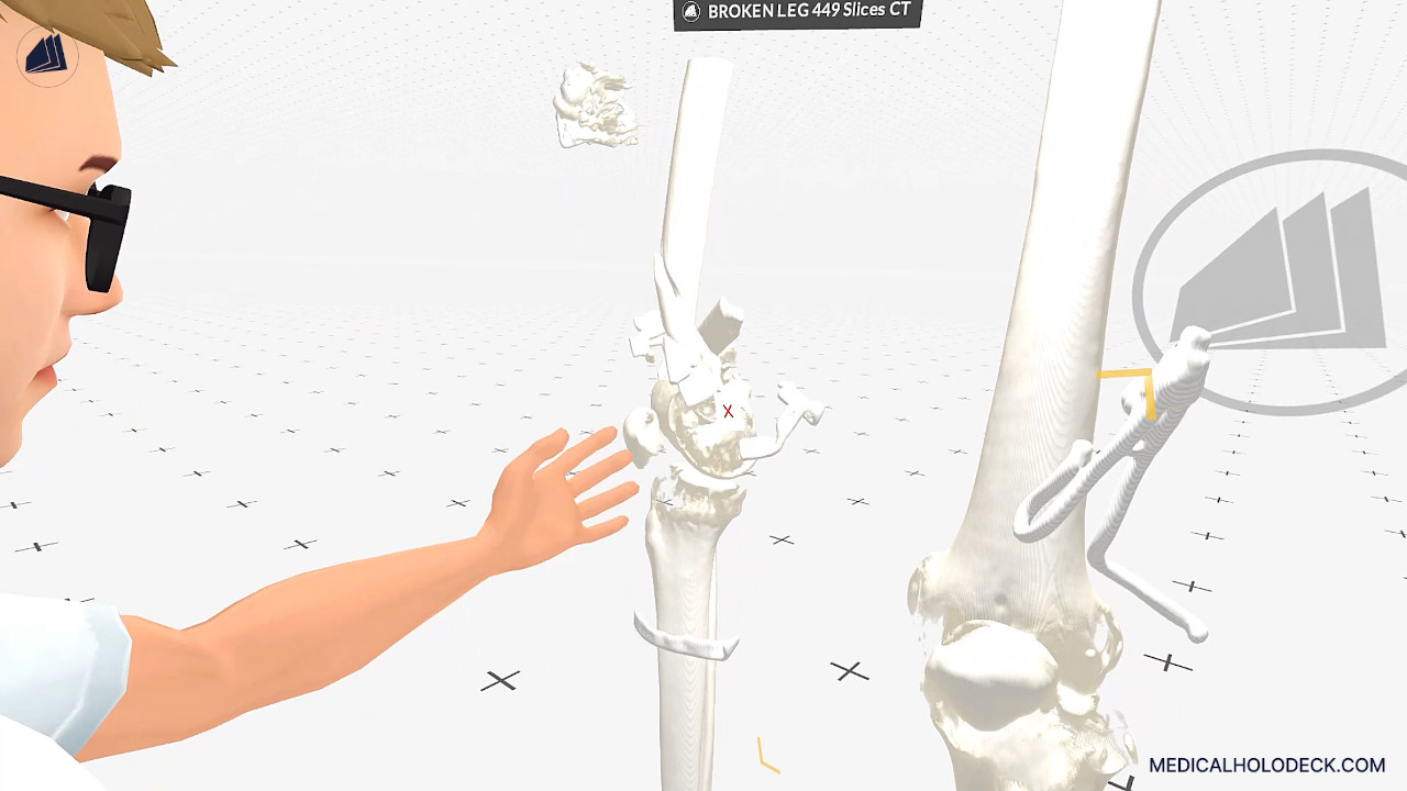 A virtual introduction into knee fractures thumbnail 5