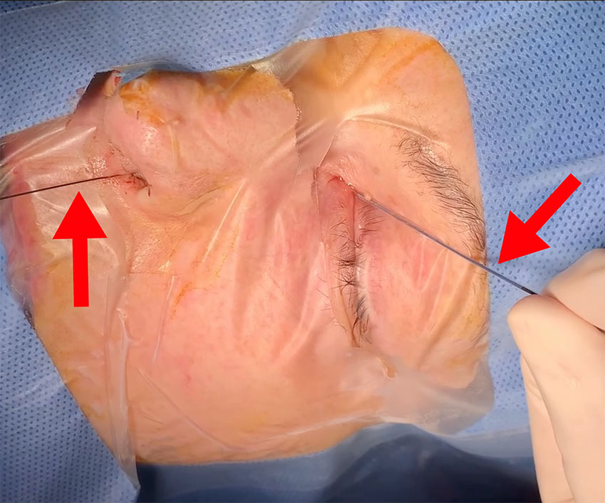 Virtual reality in endoscopic dacryoplasty