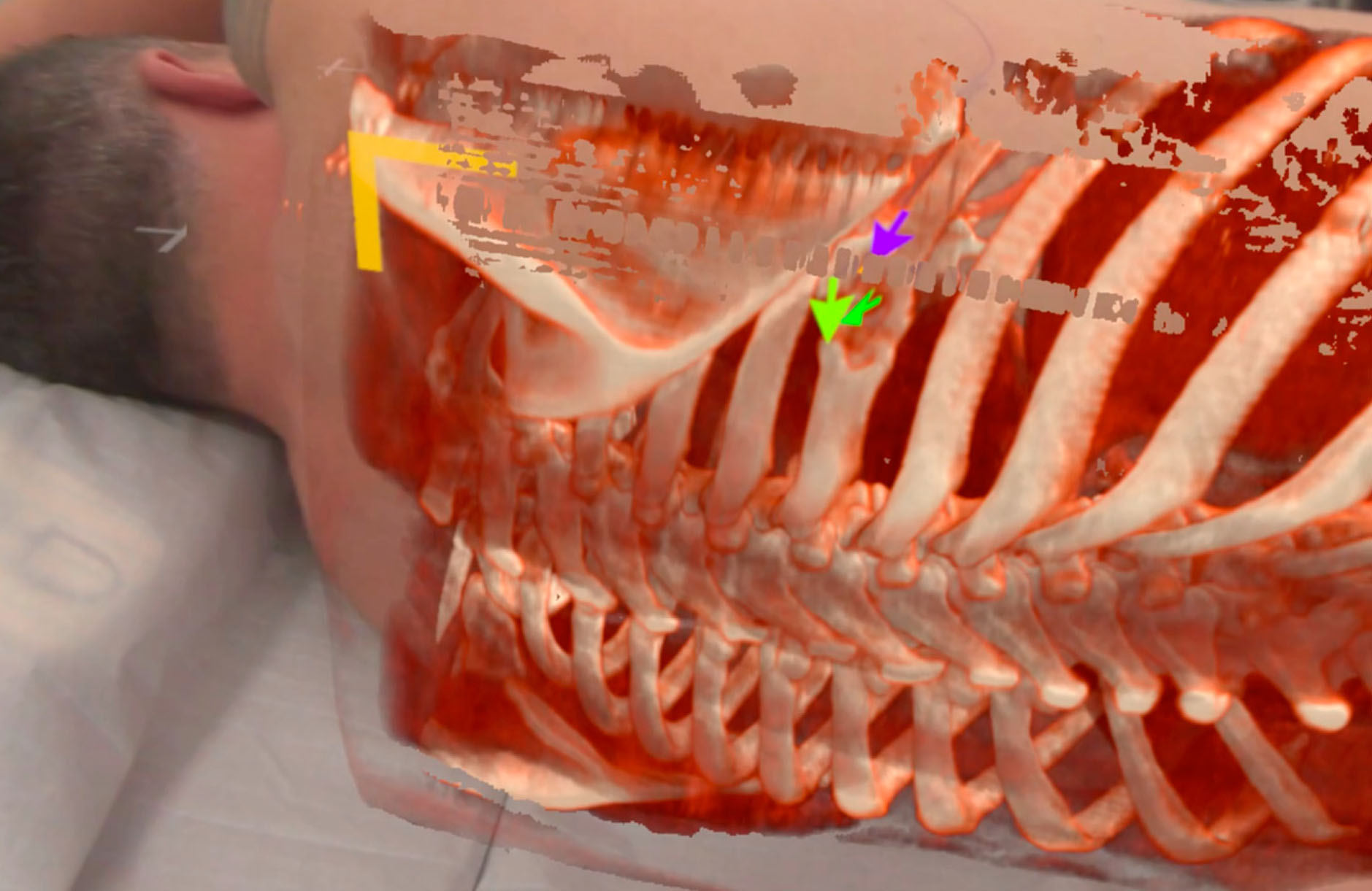 Improving thoracic surgery with mixed-reality technology